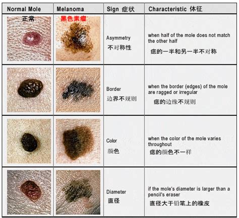 老二長痣|哪種痣是致死率超高的「索命痣」？5 大關鍵辨別癌病。